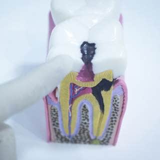 8. تسوس الأسنان