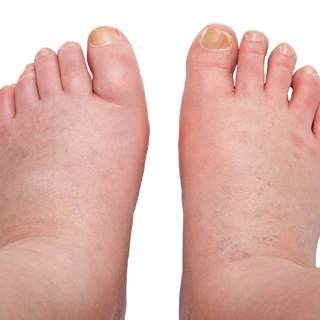 تورم القدمين