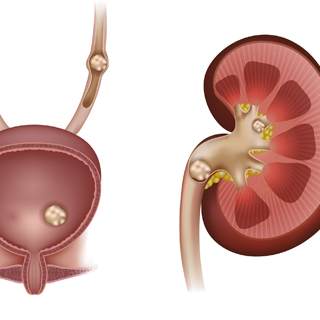 5. حصى الكلى