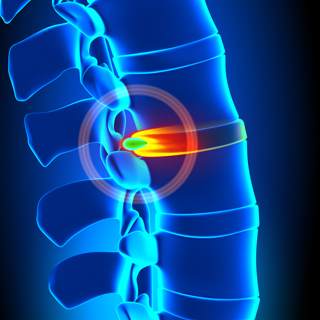 3. القرص الغضروفي