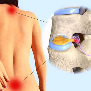 5. القرص الغضروفي