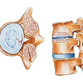 6. تضيق في العمود الفقري