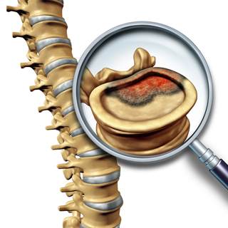 7. ورم في العمود الفقري