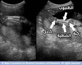 الأجزاء السفلية من رجليّ الجنين