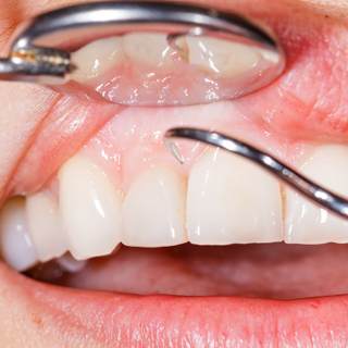 7. تراجع اللثة