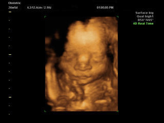 موجات فوق صوتية ثلاثية الأبعاد