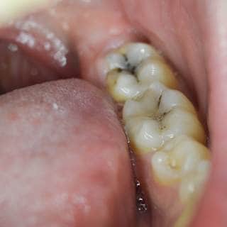 1. تسوس الأسنان