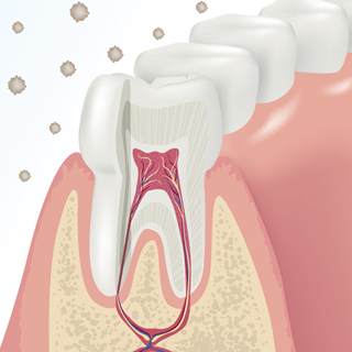 2. التهاب عصب الأسنان