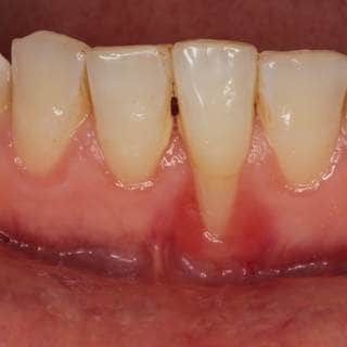 4. مشاكل اللثة