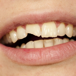 3. تكسر الأسنان