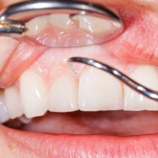 4. أمراض اللثة