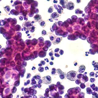 النوعان الرئيسان لسرطان الرئة النوعان الرئيسان لسرطان الرئة