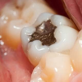 2. حشوات الأسنان