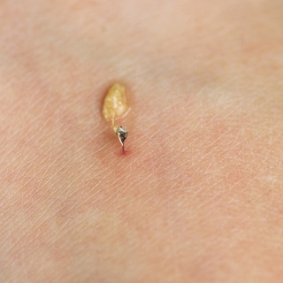 5. يعالج الجروح