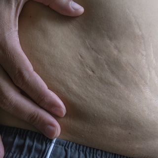 4. يقيك من التشققات والترهلات