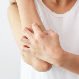 2. الحكة 2. الحكة