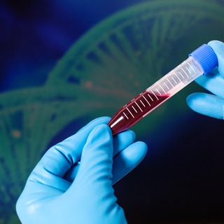 حالات الإصابة بالهيموفيليا