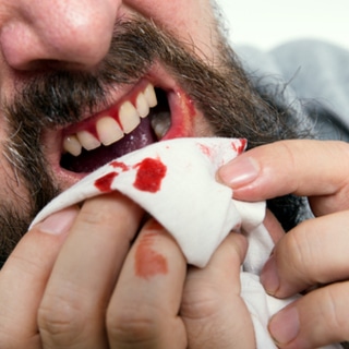 2. نزيف اللثة