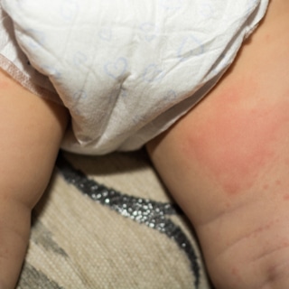 1. طفح الحفاظ يُشير إلى مشكلة صحية 