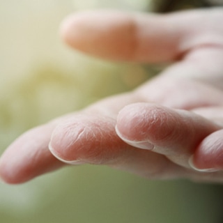 4. الجلد الجاف