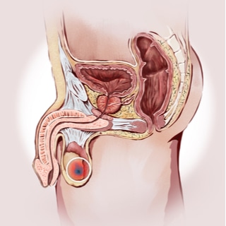 سرطان الخصية