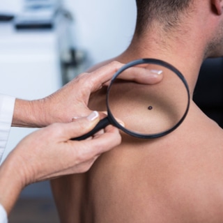 سرطان الجلد