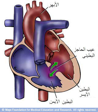 عيب الحاجز البطيني