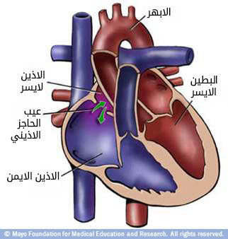 عيب الحاجز الأذيني