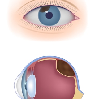 سرطان العين