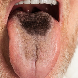 الشعر على اللسان