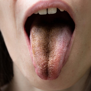 اللسان الأسود