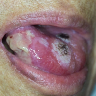 علامات سرطان الفم