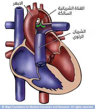 القناة الشريانية السالكة