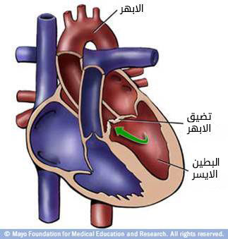 تضيق صمام الأبهر