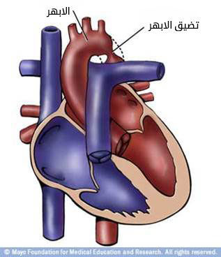 تضيّق الشريان الأبهر