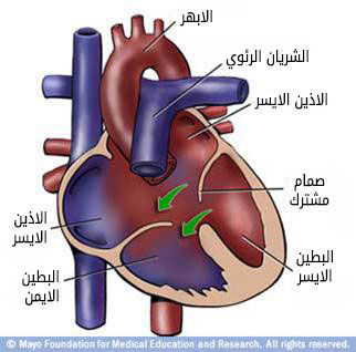 عيب الحاجز الأذيني البطيني