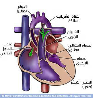 نقص التنسج في الجهة اليسرى من القلب
