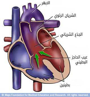 الجذع الشرياني