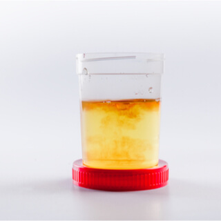 البول الغائم