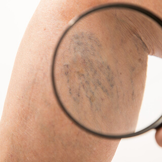 الفرق بين الدوالي والأوردة العنكبوتية الفرق بين الدوالي والأوردة العنكبوتية