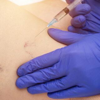 علاج الدوالي علاج الدوالي