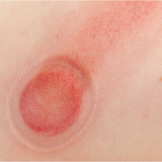 مخاطر الحجامة مخاطر الحجامة