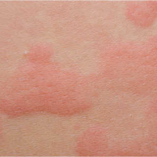 محاذير استخدام الحجامة محاذير استخدام الحجامة