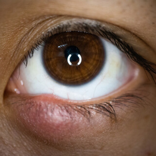 سرطان الغدد الدهنية