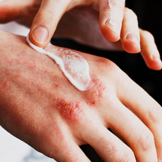 أعراض الأكزيما عند البالغين