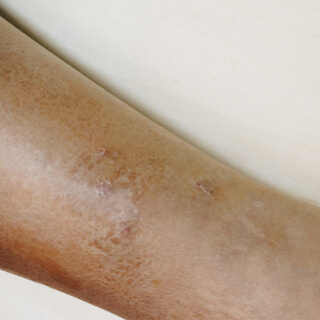 أعراض الأكزيما لدى ذوي البشرة الداكنة