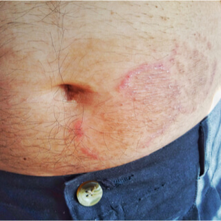 حكة اللعب Jock Itch