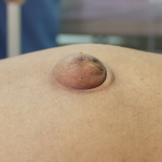 أعراض الفتق السري لدى البالغين أعراض الفتق السري لدى البالغين