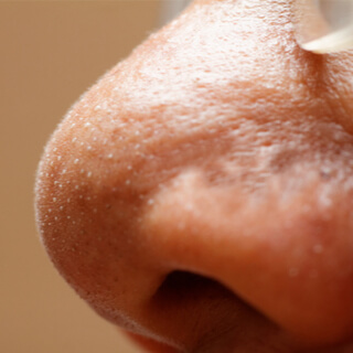 1. الرؤوس البيضاء Whiteheads