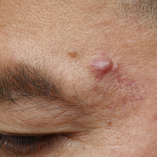 5. الكيسات Cysts